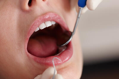 Избелване на зъби със системата на Beyond Polus Ultra с д-р Гергана Вълчева